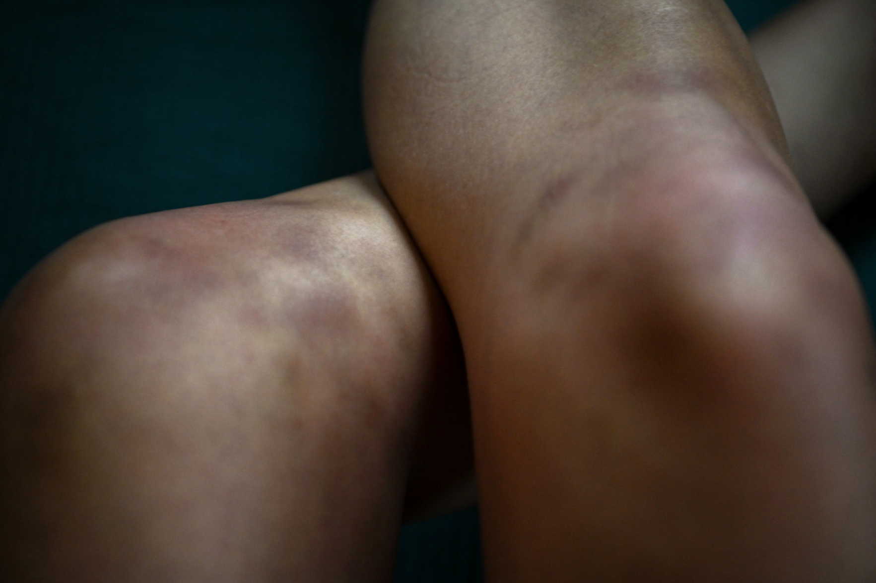 Pandemic Photo Essay: bruised knees